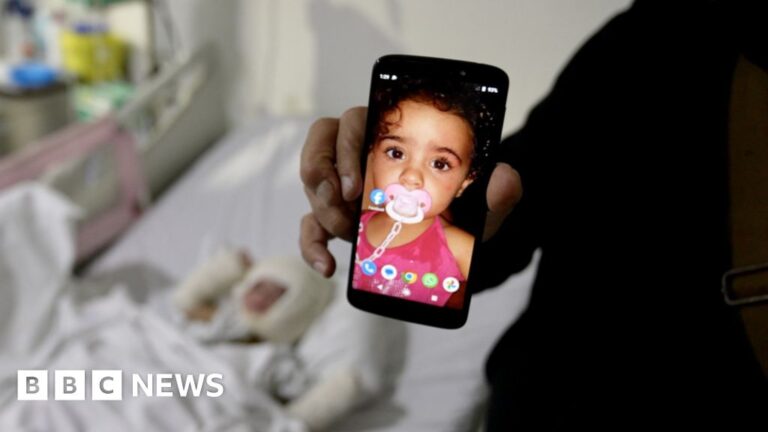 Father describes moment Israeli missile caused daughter’s third-degree burns